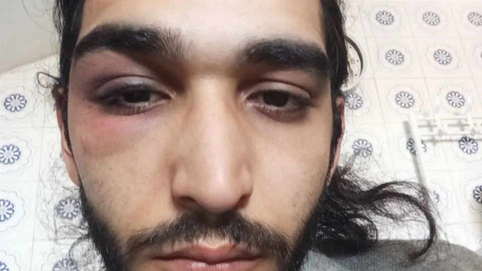 Aron, 25 anni, mostra l’occhio destro tumefatto