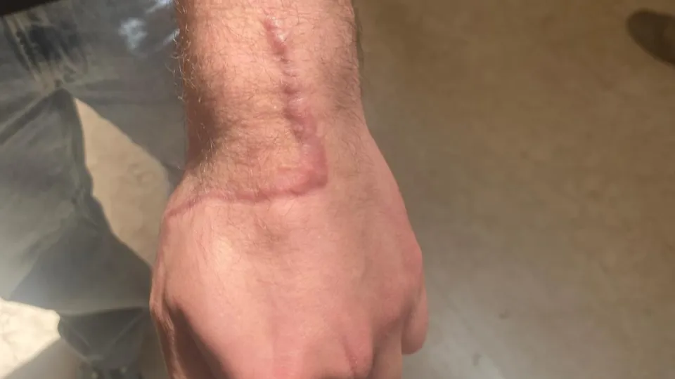 La cicatrice sulla mano del 19enne riminese